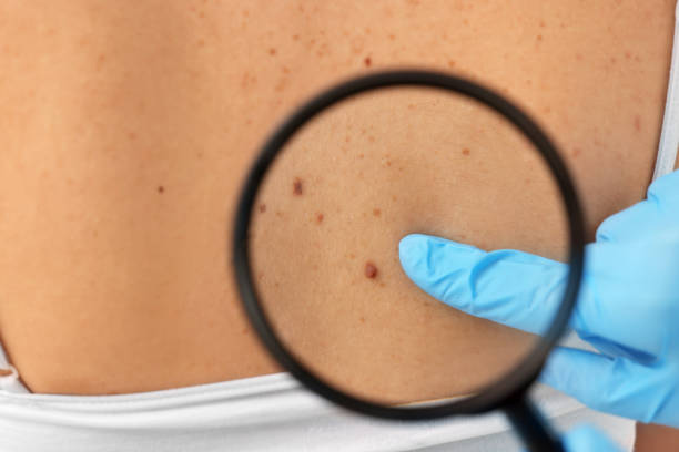 istock Dermatologist examining patient's birthmark with magnifying glass, closeup 1769780526