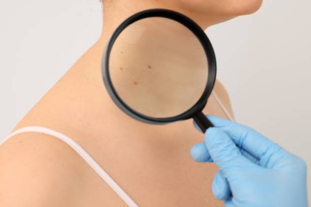 istock Dermatologist examining patient's birthmark with magnifying glass on beige background, closeup 1769780582