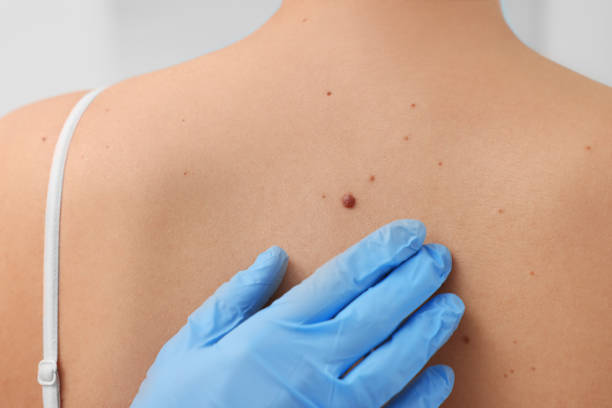 istock Dermatologist in rubber glove examining patient's birthmark, closeup view 1769781103