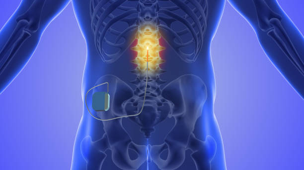 Spinal cord stimulation medical concept Spinal cord stimulation (SCS) is a medical procedure used to manage chronic pain, especially when other treatments have been unsuccessful. It involves the implantation of a device that delivers electrical impulses to the spinal cord. The primary goal of SCS is to reduce pain and improve the patient's overall quality of life. Here's how the procedure typically works .SCS is often used to treat various chronic pain conditions, including failed back surgery syndrome, complex regional pain syndrome (CRPS), neuropathic pain, and some forms of intractable leg pain. It may also be considered for patients who are not suitable candidates for other pain management treatments or who wish to avoid or reduce the use of opioids and other pain medications. skin diagram photos stock pictures, royalty-free photos & images