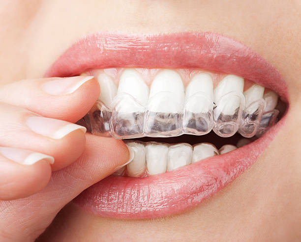 teeth with whitening tray teeth with whitening tray tooth whitening photos stock pictures, royalty-free photos & images