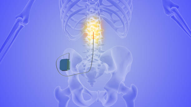 The medical notion of spinal cord stimulation Spinal cord stimulation (SCS) is a medical procedure used to manage chronic pain, especially when other treatments have been unsuccessful. It involves the implantation of a device that delivers electrical impulses to the spinal cord. The primary goal of SCS is to reduce pain and improve the patient's overall quality of life. Here's how the procedure typically works. SCS is often used to treat various chronic pain conditions, including failed back surgery syndrome, complex regional pain syndrome (CRPS), neuropathic pain, and some forms of intractable leg pain. It may also be considered for patients who are not suitable candidates for other pain management treatments or who wish to avoid or reduce the use of opioids and other pain medications. spinous process stock pictures, royalty-free photos & images