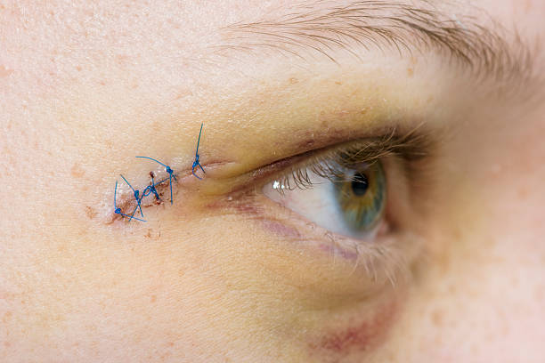 Injured Eye With Blue Stitches Stock Photo - Download Image Now - Medical  Stitches, Stitching, Human Eye - iStock