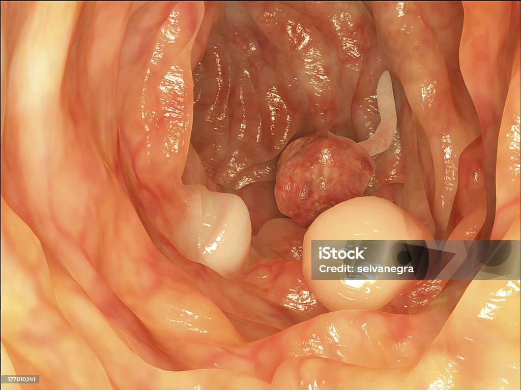 Intestinal polyps Typical forms of intestinal polyps. Colorectal Cancer Stock Photo