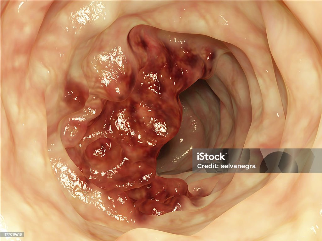 Tumeur tube Intestinal - Photo de Coloscopie libre de droits