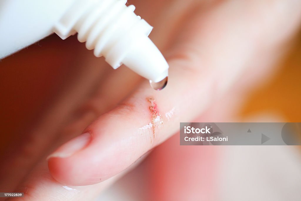 disinfect the scratch by rubbing in alcohol disinfect the scratch by rubbing in alcohol cuts on the hand Wound Stock Photo