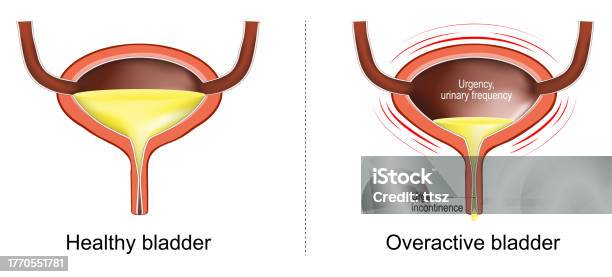 Separation Bladder Overactive Bladder Loss Of Bladder Control Stock Illustration ...