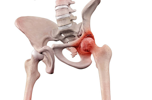 istock Osteoarthritis femur head pain 1770860377