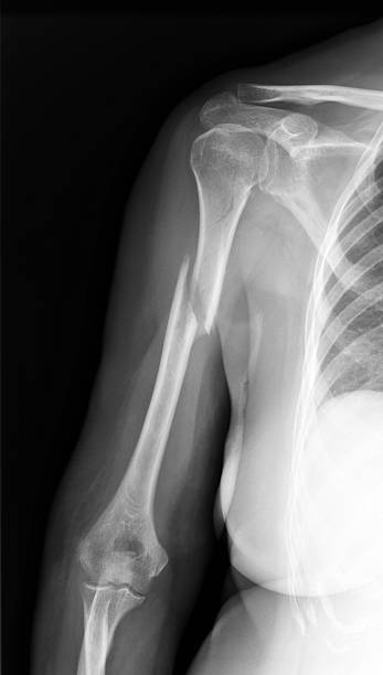 x-ray de broken arm. - humerus photos et images de collection