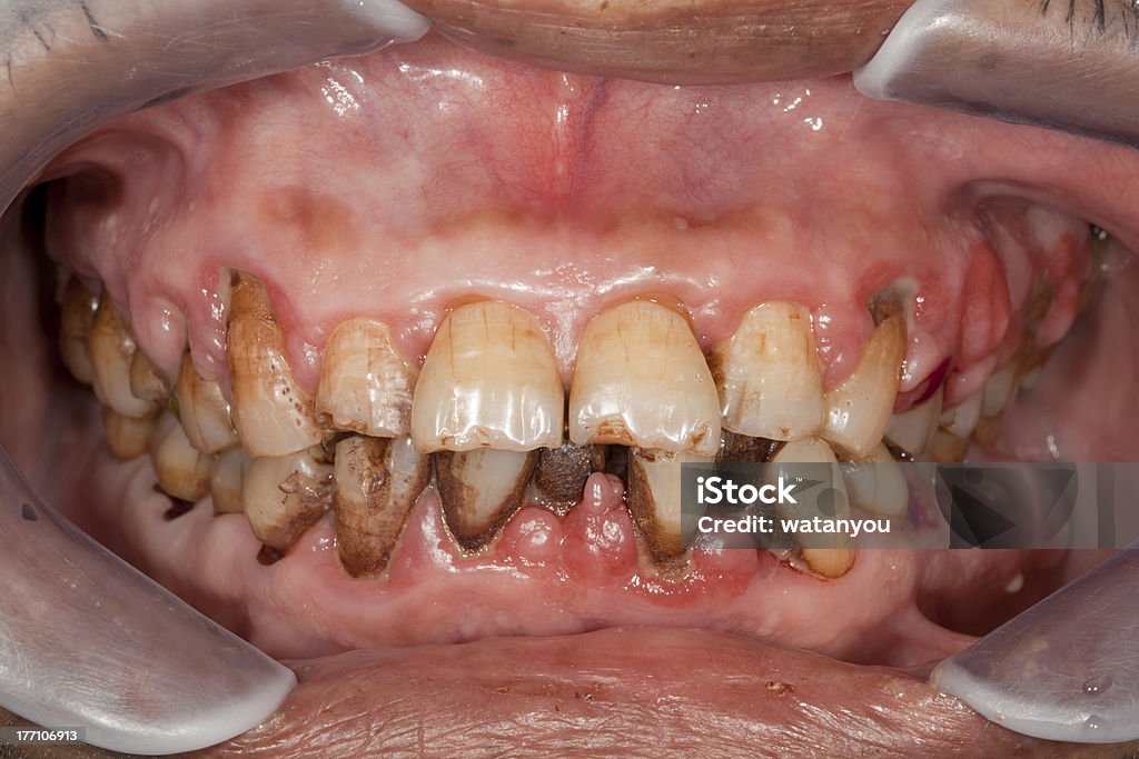 Periodontitis - Foto de stock de Doença Periodontal royalty-free