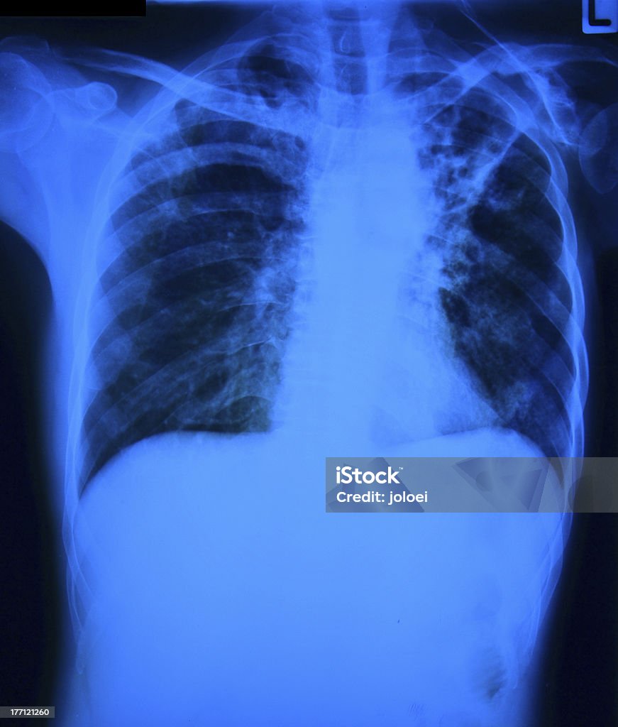 Brust x-ray-film - Lizenzfrei Anatomie Stock-Foto
