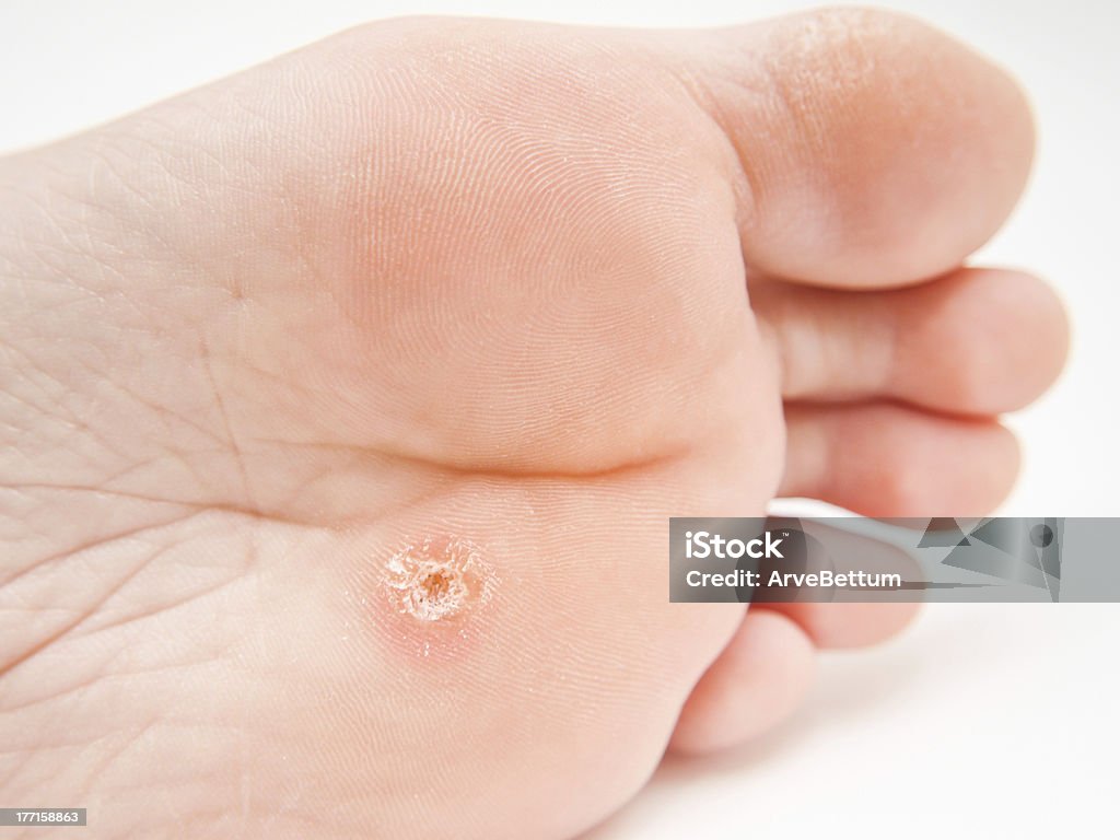 Callus under foot Person with callus located under foot, close to toes towards white Callus Stock Photo