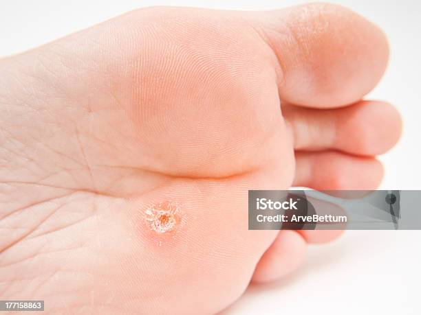 Callus Under Foot Stock Photo - Download Image Now - Callus, Dermatology, Horizontal