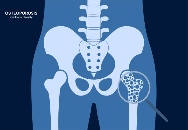 Osteoporosis medical poster vector art illustration
