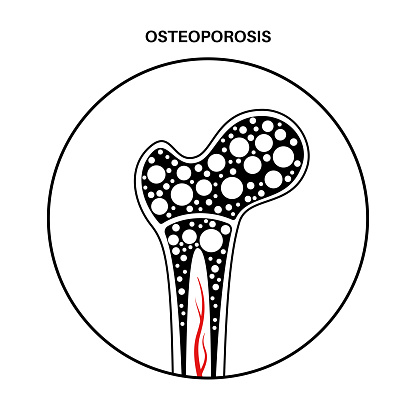 Osteoporosis disease. Systemic skeletal disorder, loss of bone mineral density. Increased risk of hip fracture, morbidity and mortality in the elderly. Deterioration of bone tissue vector illustration