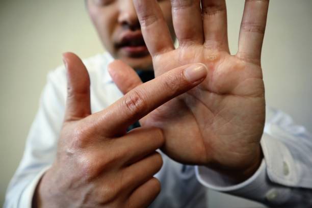 istock Japanese man pointing at blisters on his hand 1771643244