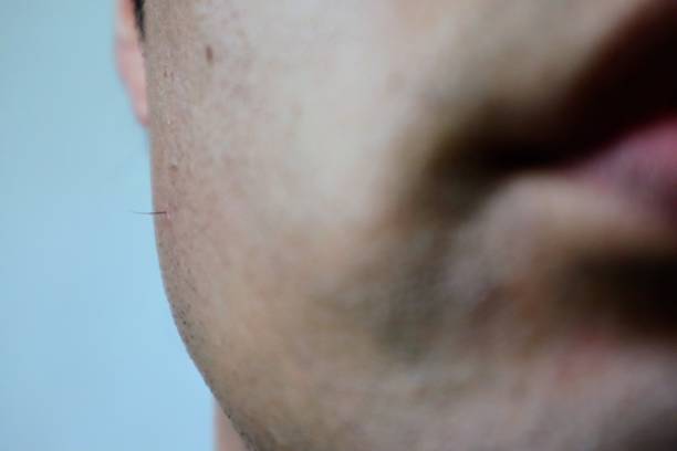 istock Close-up of ingrown beard hair 1771750937