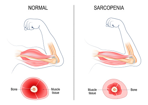 Sarcopenia. Age-related muscle atrophy. Comparison and Difference between normal arm and Muscle loss. Cross section of muscle of Young active person, and Old passive human. Vector illustration