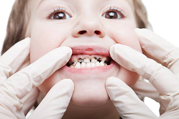 Caries teeth decay Dental medicine and healthcare - child patient open mouth showing caries teeth decay dental cavity photos stock pictures, royalty-free photos & images