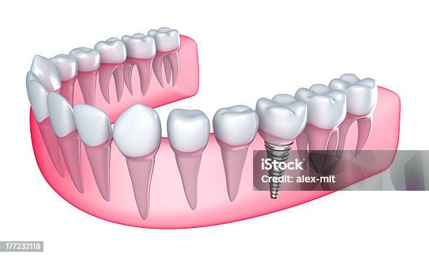 Зубной Имплантат В Гум — стоковые фотографии и другие картинки Белый - Белый, Горизонтальный, Здоровье зубов