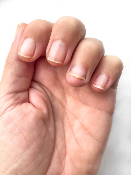 istock broken and damaged female nails after removing hybrid manicure 1772321473