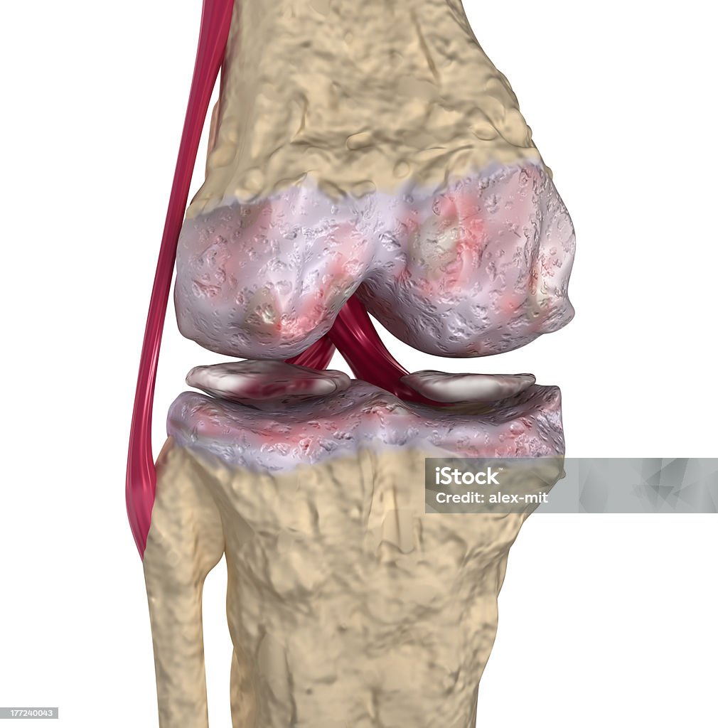 Osteoartritis: Articulación de la rodilla con ligaments y cartilages - Foto de stock de Osteoartritis libre de derechos