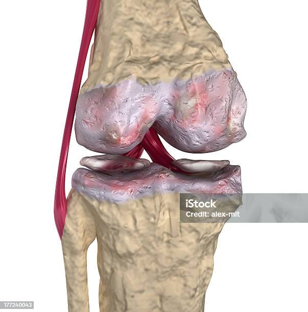 Osteoartritis Articulación De La Rodilla Con Ligaments Y Cartilages Foto de stock y más banco de imágenes de Osteoartritis