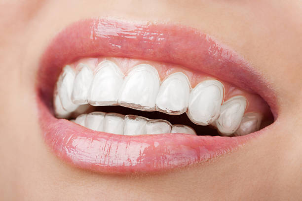 lächeln mund mit zahn-tablett zahnaufhellung - zahnschiene stock-fotos und bilder