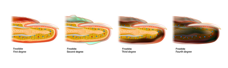 The four frostbite stages.Skin injury that occurs when exposed to extreme low temperatures, causing the freezing of the skin or tissues.