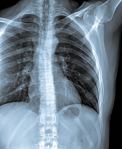 istock x-ray of an human cage 177255634