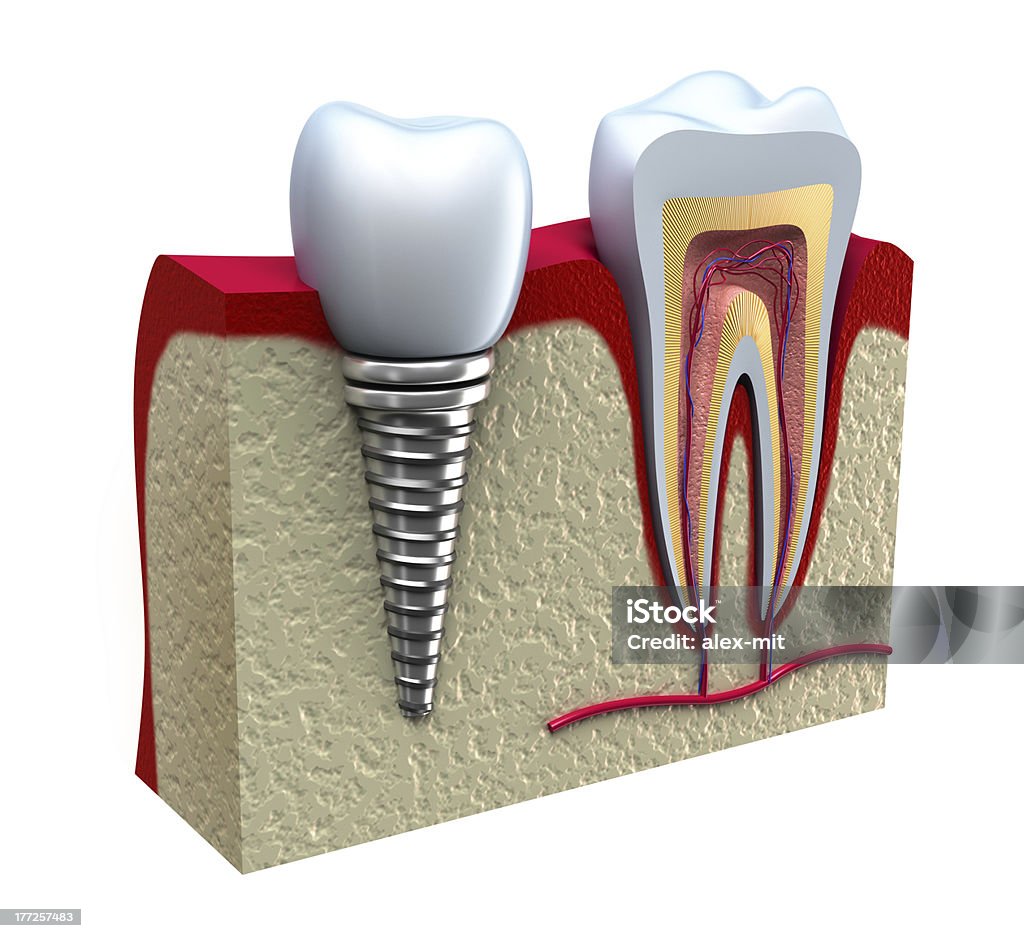 Анатомия здоровые зубы и Зубной имплантат в Челюстная кость. - Стоковые фото Зубной имплантат роялти-фри