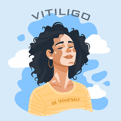 Happy woman with Vitiligo skin problems. Flat vector illustration. Self acceptance, self love concept. Poster, banner, card World Vitiligo Day