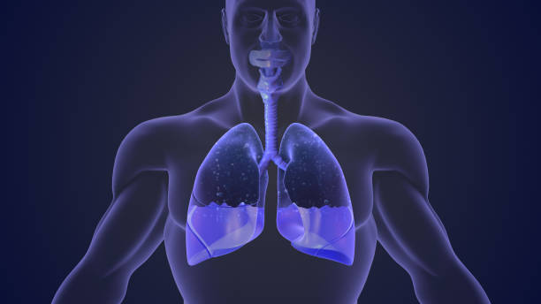 istock Pleural effusion represents inadequate disposal 1772711996