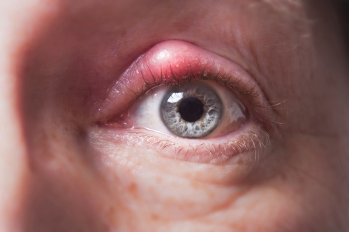 Closeup of an inflamed eye with a purulent sty