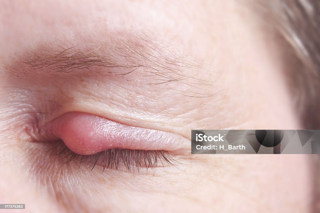 closed eye with hordeolum Closeup of a seriously infected eyelid with sty Stye - Infection Stock Photo