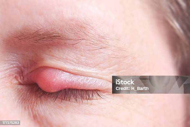 Closed Eye With Hordeolum Stock Photo - Download Image Now - Stye - Infection, Abscess, Bacterium