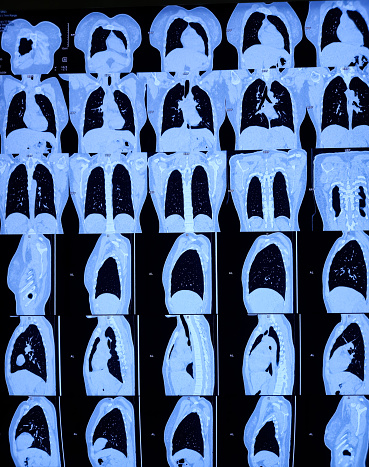 Multi slice HRCT scan of chest showing normal study, normal appearance of the lungs, parenchyma, pulmonary vasculature, mediastinal structures, no adenopathy, no pleural effusion, no abnormality.
