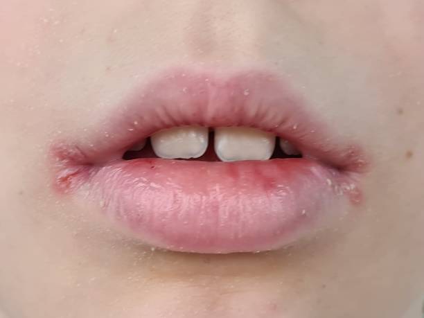 istock Herpes on lips of child. Treatment ointment 1773235449