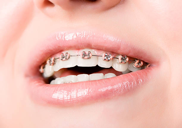 istock Beautiful young woman with brackets on teeth 177329687
