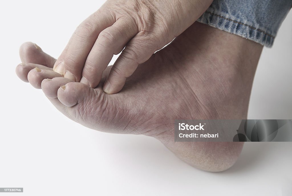 Hombre con comezón los dedos de los pies - Foto de stock de Neuropatía libre de derechos