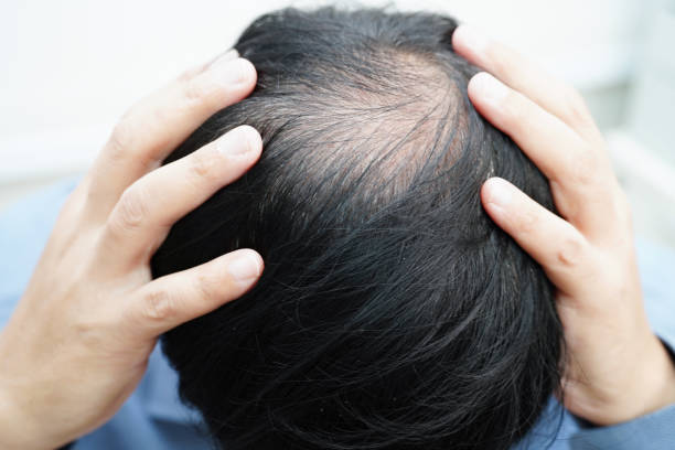 istock Bald head in man, hair loss treatment health problem. 1773527096