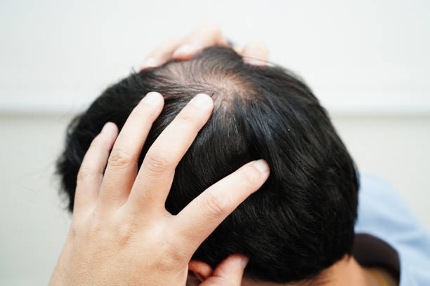 istock Bald head in man, hair loss treatment health problem. 1773528898