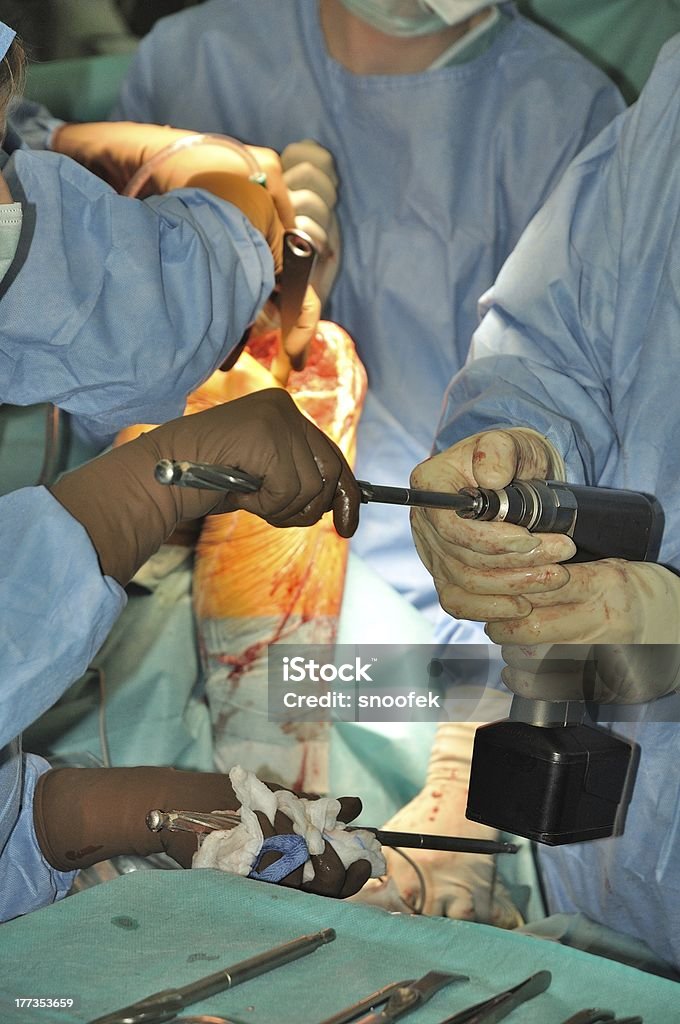Protezy stawu kolanowego - Zbiór zdjęć royalty-free (Anatomia człowieka)