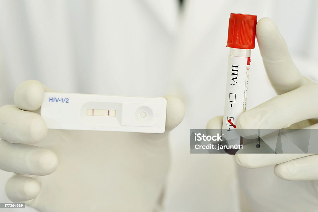 HIV positive A lab technician show a blood sample with HIV positive result AIDS Stock Photo