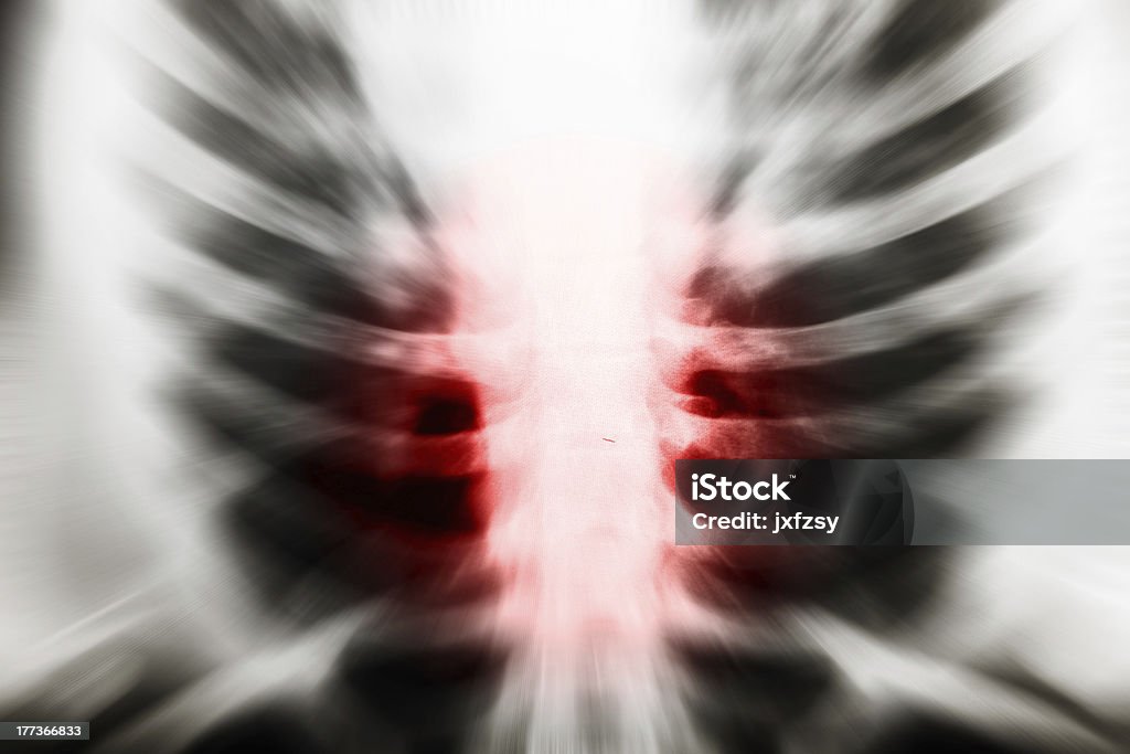 Radiografia del torace - Foto stock royalty-free di A petto nudo