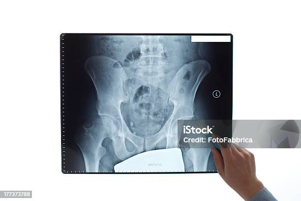 Analysieren Von Xray Stockfoto und mehr Bilder von Leistenregion - Leistenregion, Kreuzbein, Medizinisches Scannen