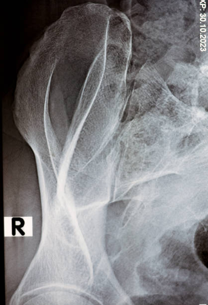 digitale röntgenuntersuchung des iliosakralgelenks röntgenaufnahme zeigt erhaltene iliosakralgelenksräume und glatte gelenkoberflächen, konzept für rückenschmerzen, selektive fokussierung des röntgens auf die beckengelenke - x ray image x ray back low stock-fotos und bilder