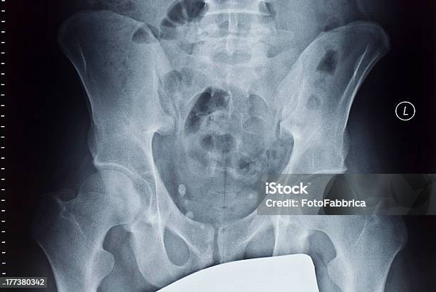 Foto de Xray e mais fotos de stock de Acetábulo - Acetábulo, Adulto, Anatomia