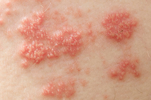 Shingles Raised red bumps and blisters caused by the shingles virus bumpy photos stock pictures, royalty-free photos & images