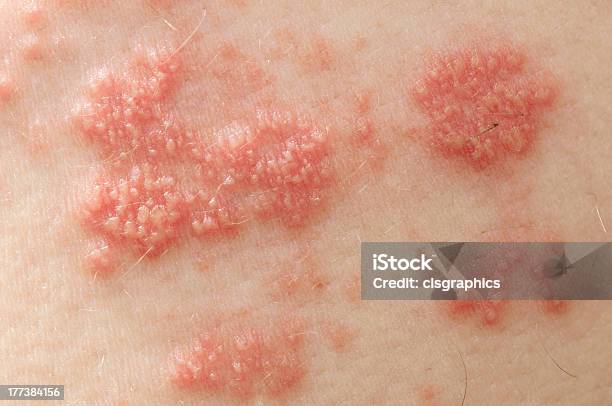 Shingles Stock Photo - Download Image Now - Shingles, Herpes, Skin Condition